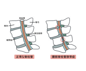 左（正常な脊柱管）右（腰部脊柱管狭窄）
